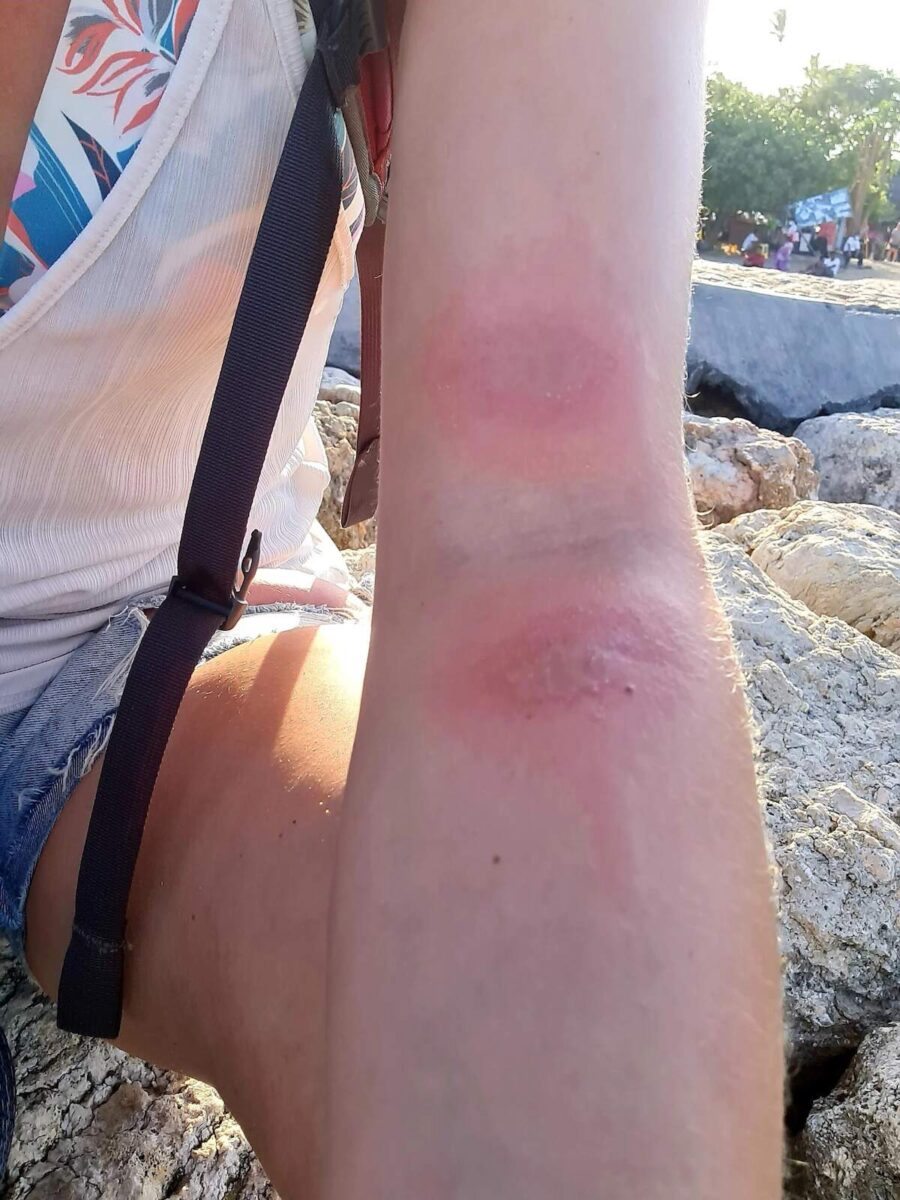 Close-up of a ringworm rash on a solo female traveler in Ubud, highlighting the importance of skincare and hygiene in Bali's humid climate.